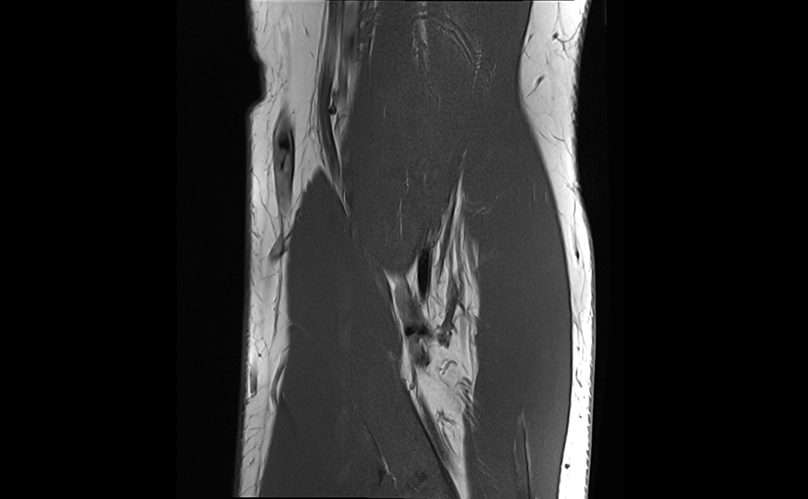 MRI elbow ligaments coronal cross sectional anatomy 3T  radiology  image-img-07001-00011.webp